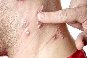 Herpes zoster (Mal-der) and Hypnotherapy (Maetrawun)—what should one do