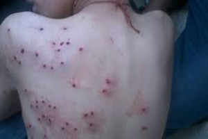 Pellet victims avoid treatment in Kashmir ‘to evade arrests’