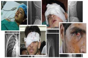 Every 2nd hour, ‘Lethal’ Pellets rupture an eye in Kashmir