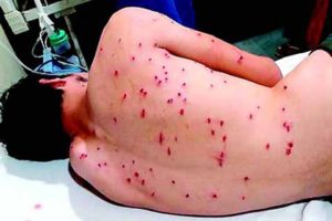 over-300-new-pellet-victims-admitted-at-smhs-in-11-days