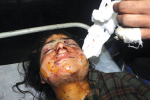 50-hurt-in-clashes-in-south-kashmir-on-115th-day-of-unrest-scores-fired-with-pellets-in-face