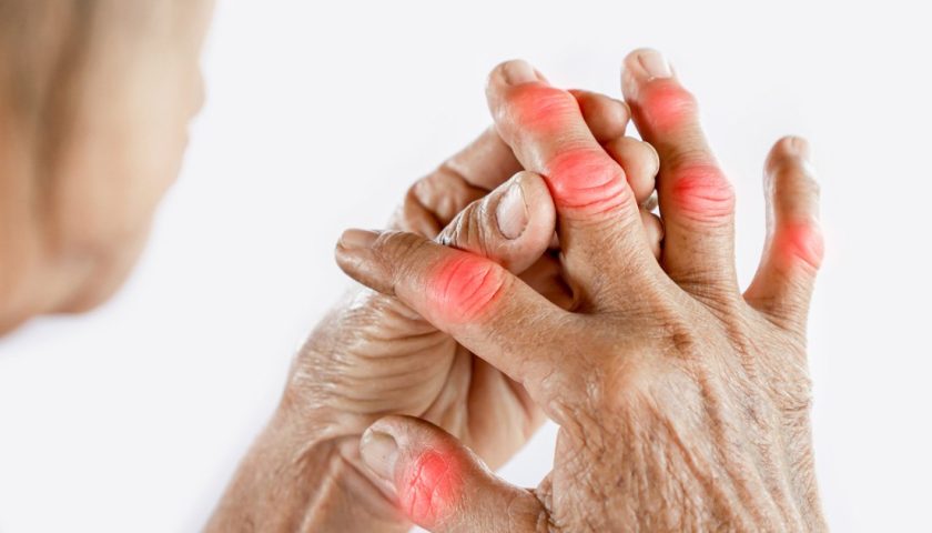 Rheumatoid Arthritis; Signs, Symptoms and Causes