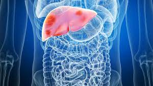 Fatty liver may increase risk of personality disorders by threefold: Study