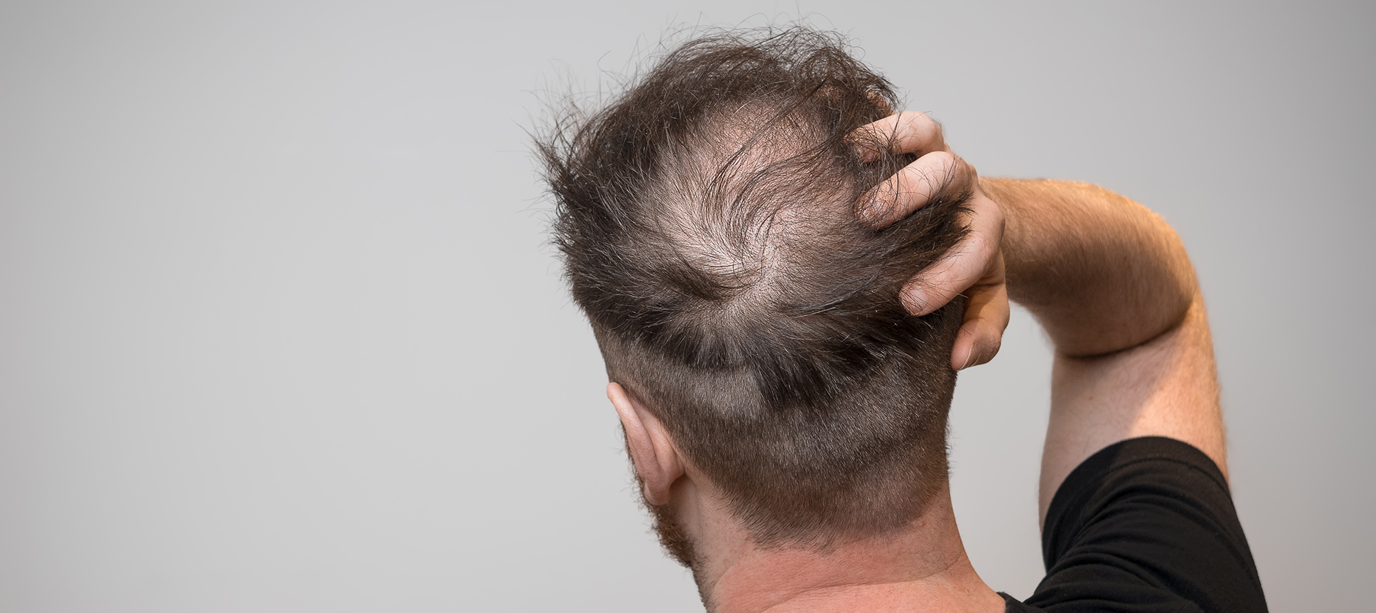 Reclaim Your Hairline: Expert Tips to Control Male Hair Loss